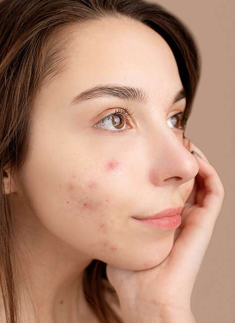 Acne 101 Types Of Acne Severity