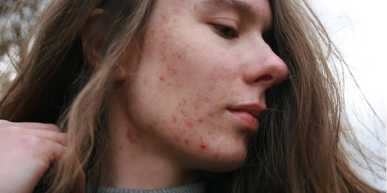 Acne And Mental Health Emotional Impacts Of Acne Featured