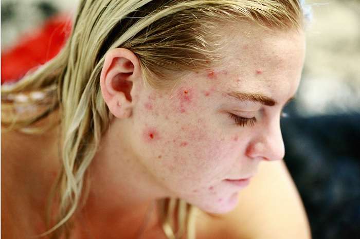 Acne And Mental Health Emotional Impacts Of Acne Mental